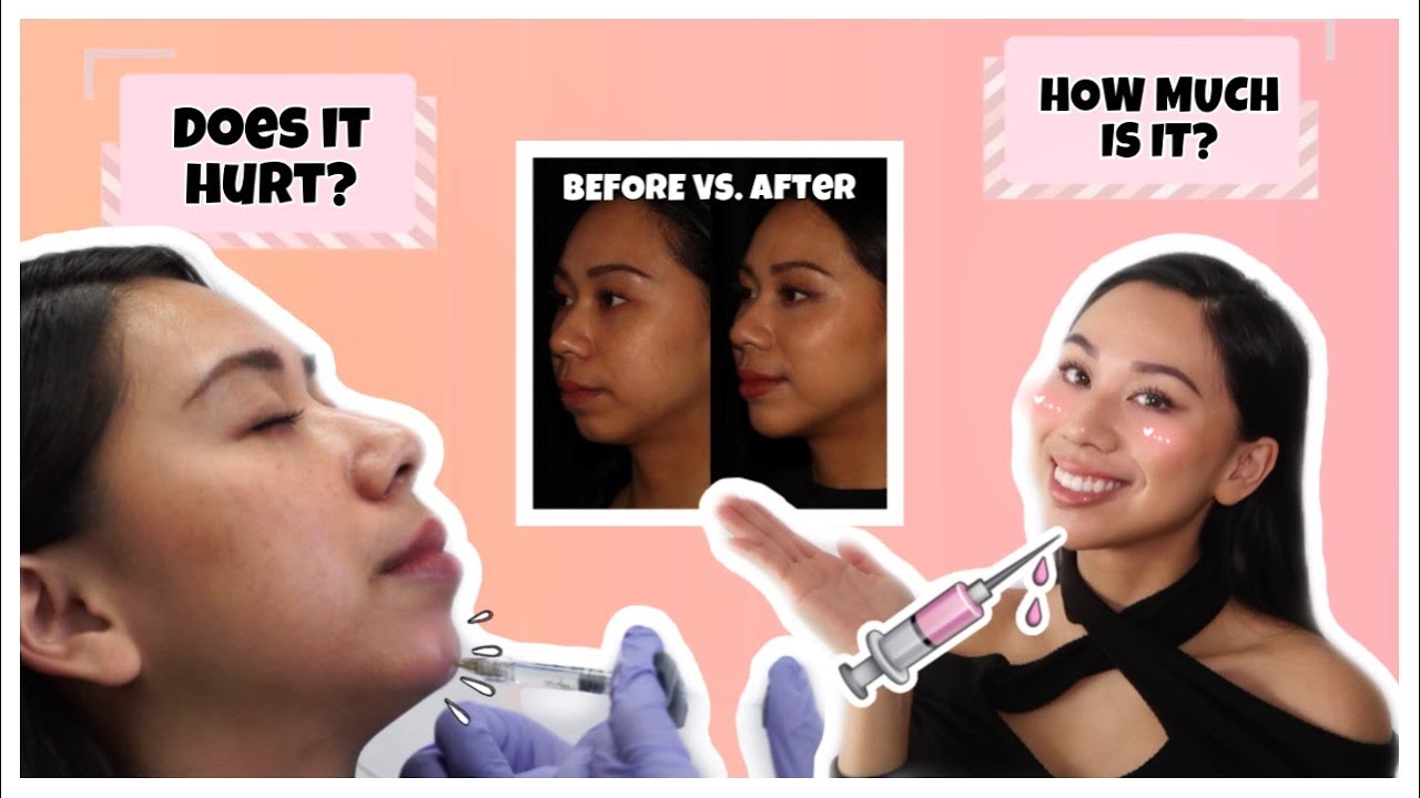 SHOCKING BEFORE AND AFTER CHIN FILLER TRANSFORMATION 😍 | Q&A WHAT YOU NEED TO KNOW