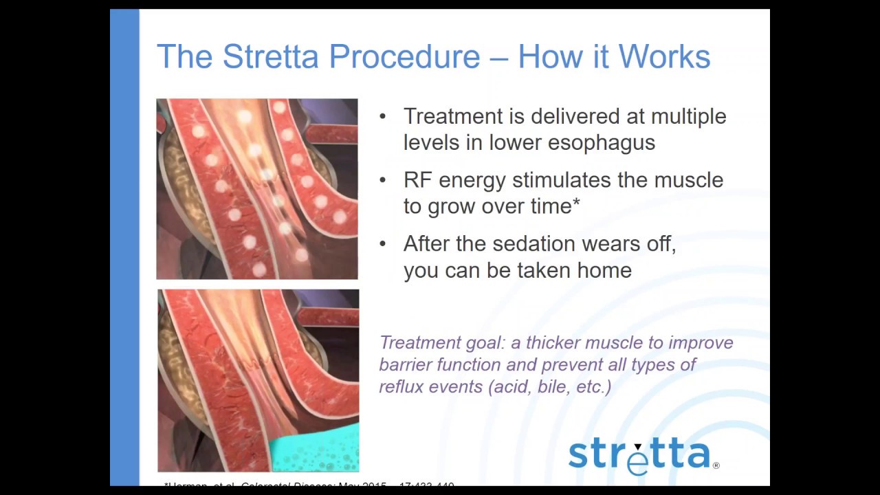 Stretta Patient Webinar 2017 Dr Reiss