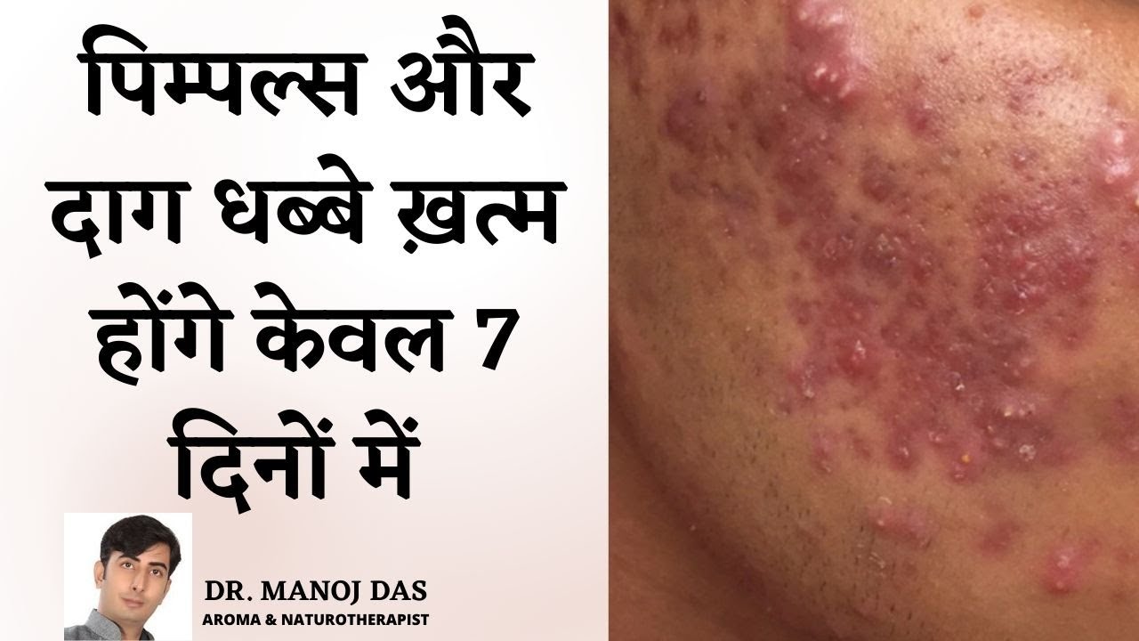 पुराने से पुराने पिम्पल्स जड़ से ख़त्म I GET RID OF PIMPLES AND ACNE PERMANANTLY | DR. MANOJ DAS