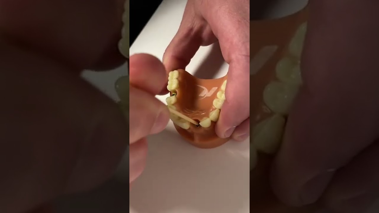 Broken Abutment Screw Removal