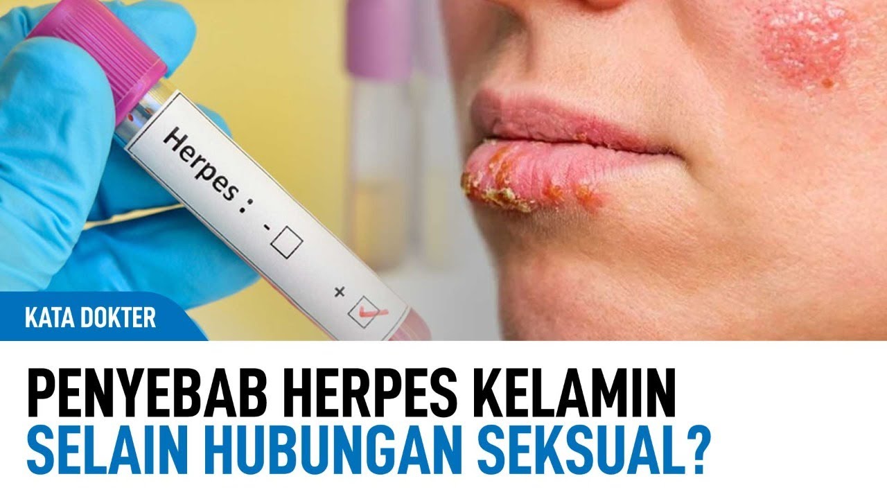 Bagaimana Penularan Herpes Selain Hubungan Badan? | Kata Dokter