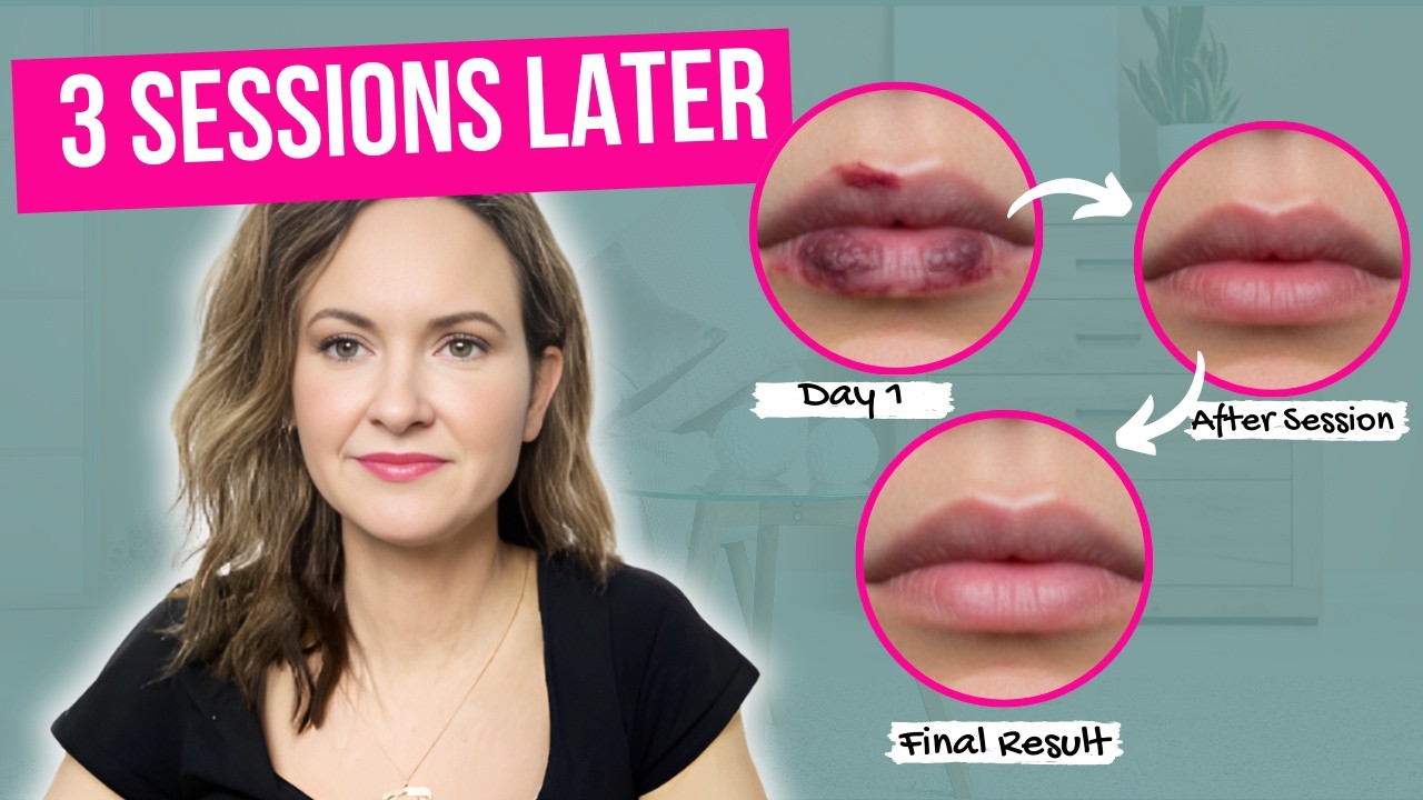 Repairing a Traumatic Lip Scar Across the Vermilion Border with Laser & Steroid Treatment