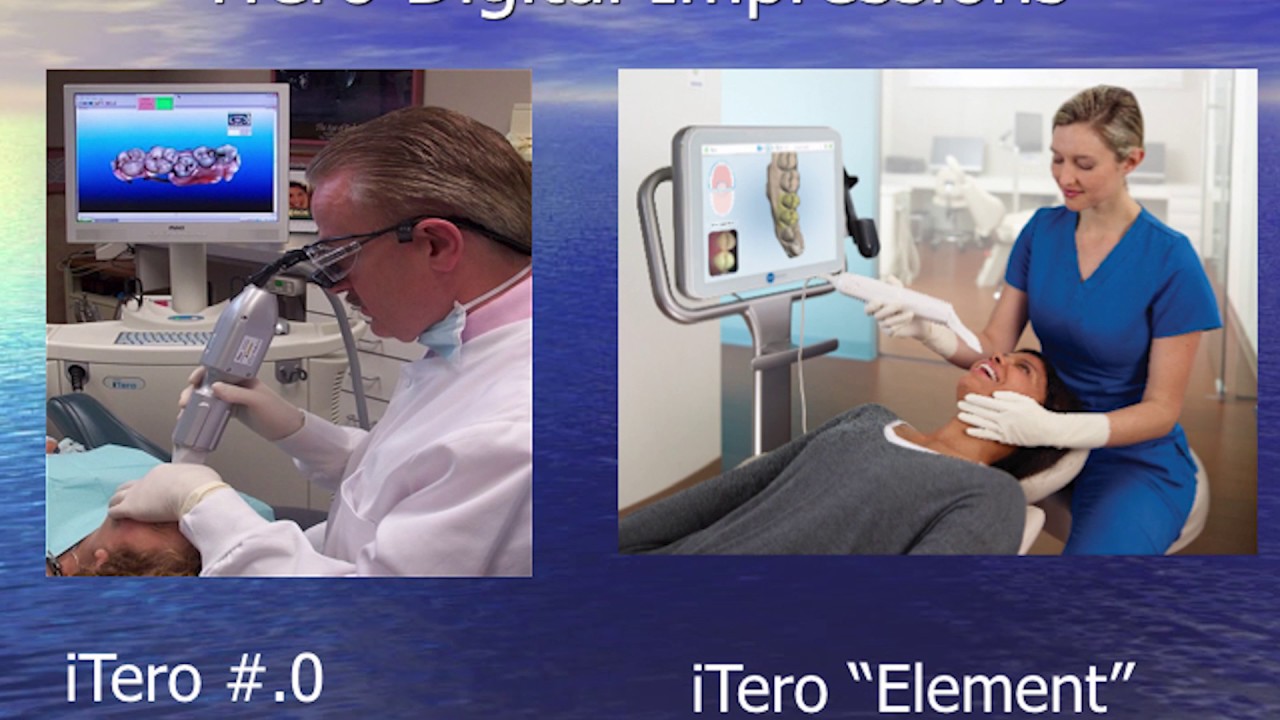 iTero Digital Impressions vs Traditional Impressions