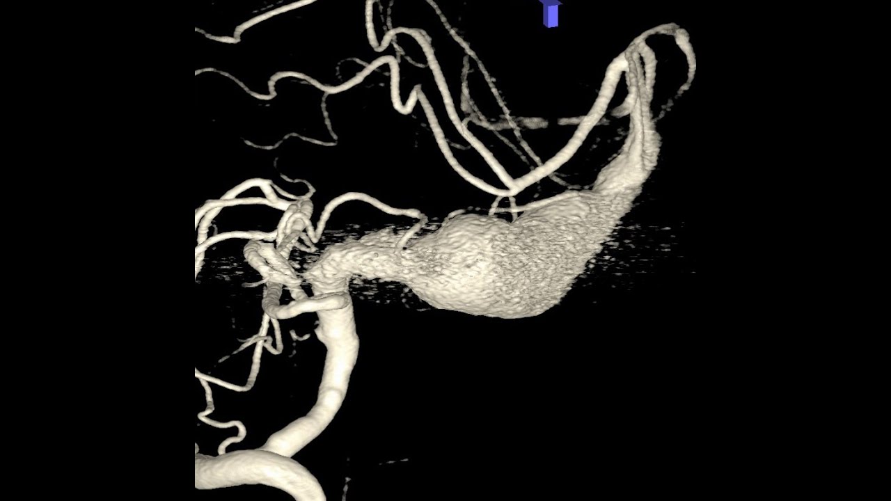 Giant cerebral basilar artery fusiform aneurysm - Edovascular treatment