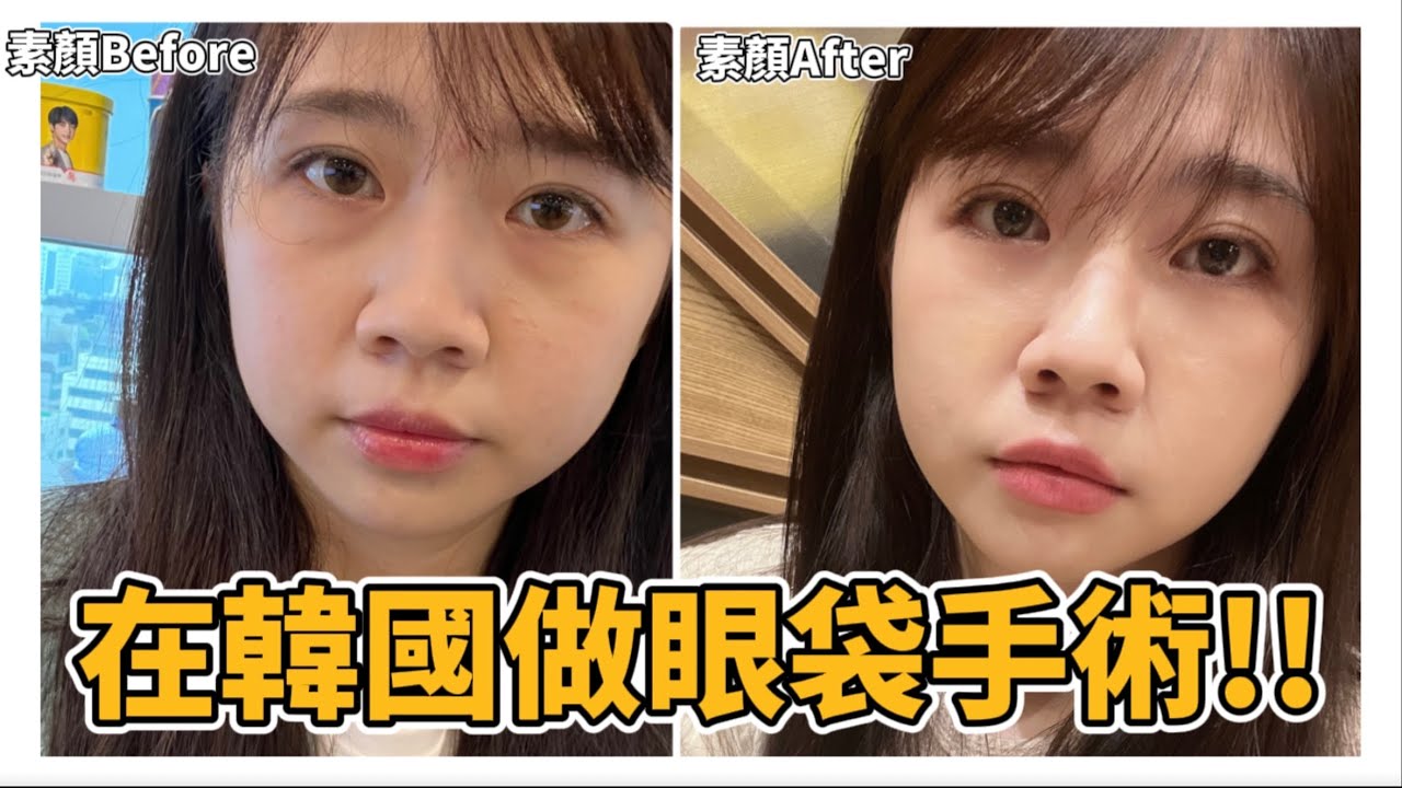 終於在韓國做眼袋手術啦!!😱內開眼袋、填補淚溝術後全記錄｜無傷口？7天恢復？費用？後遺症？📝｜紹紹Soy Daily
