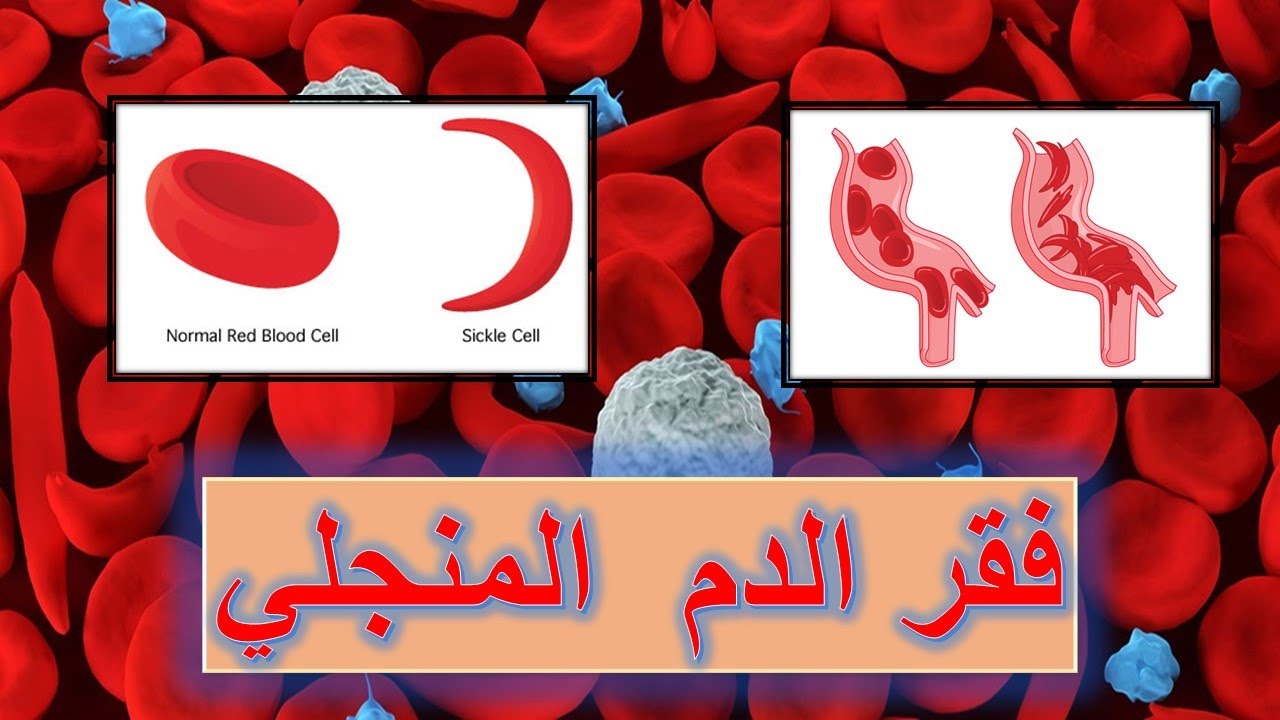 فقر الدم المنجلي😨😨 - بالمختصر المفيد