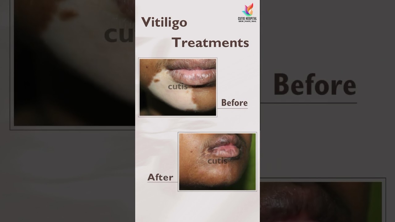 Vitiligo treatment | Cutis Hospital Bangalore | Vitiligo Before and After