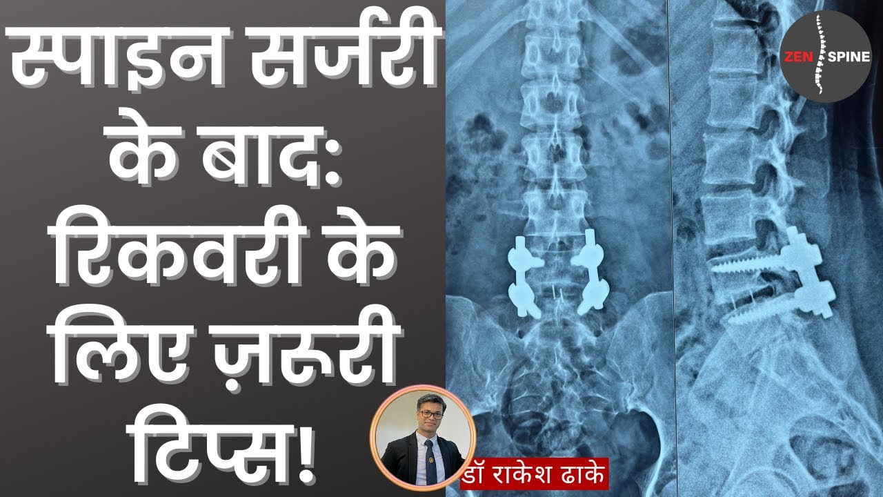स्पाइन सर्जरी के बाद कब शुरू करें अपनी रूटीन जिंदगी?