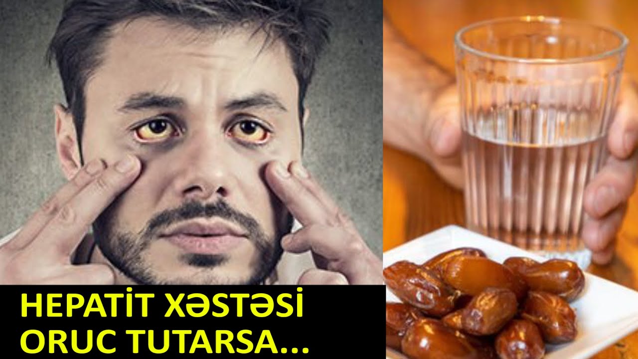 Hepatit xəstələri! - Oruc tuta bilərmi?