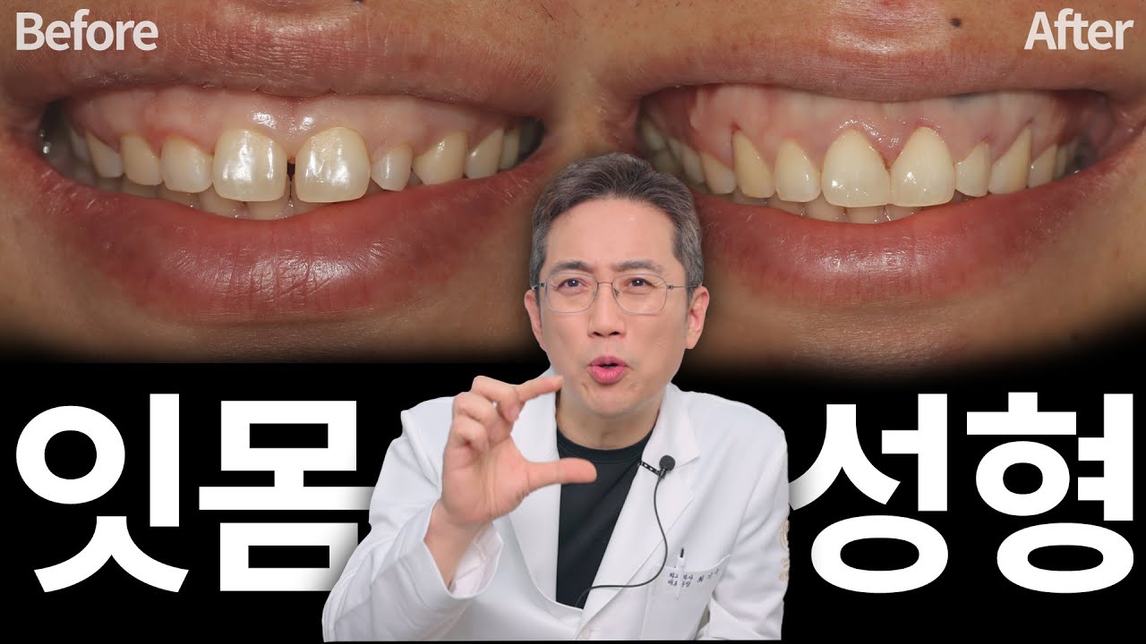 치아 수리남이 직접 얘기해 주는 잇몸 성형의 모든 것!