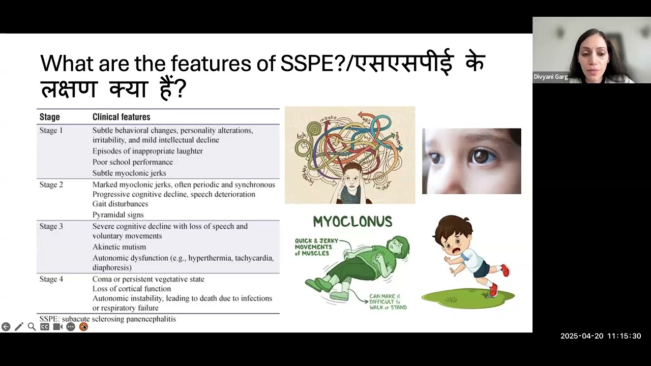 Subacute Sclerosing Panencephalitis (SSPE)