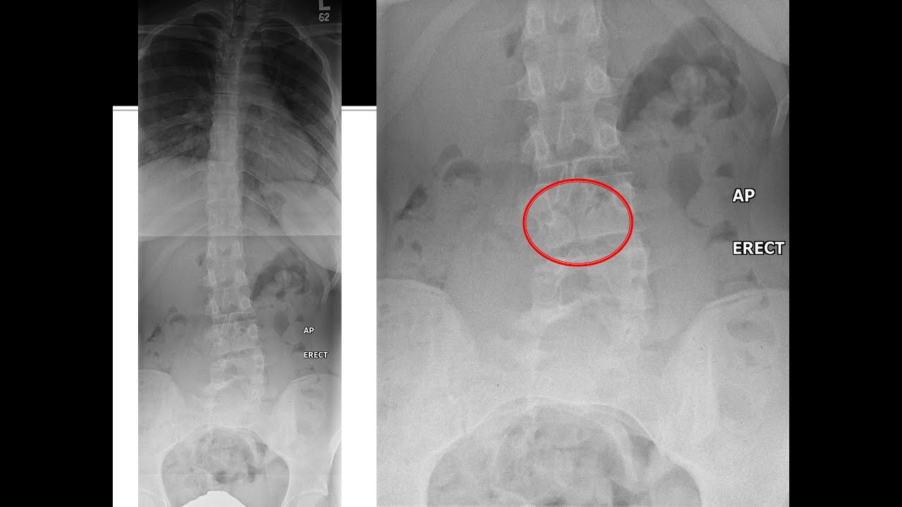 Lumbar Spine MRI Part 3: Scoliosis, Spondylolisthesis