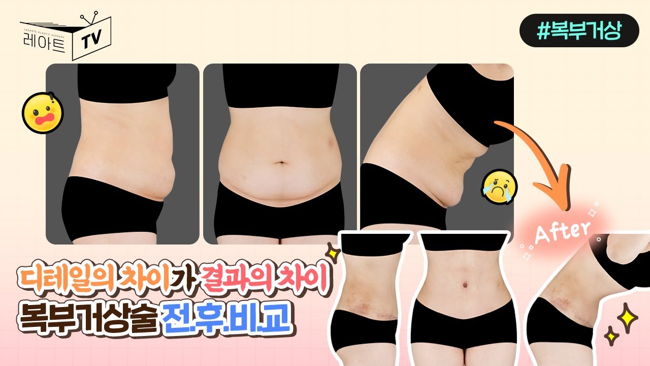 [복부거상수술] 전후 차이는 디테일의 차이에서 옵니다😉[레아트성형외과]