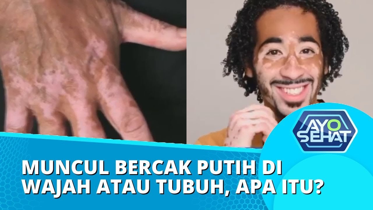 Mengenal Vitiligo, Penyakit Kehilangan Pigmentasi pada Kulit! | AYO SEHAT