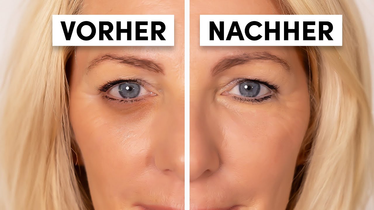 Wieder natürlich strahlen: Ursache von dunklen Augenringen beheben