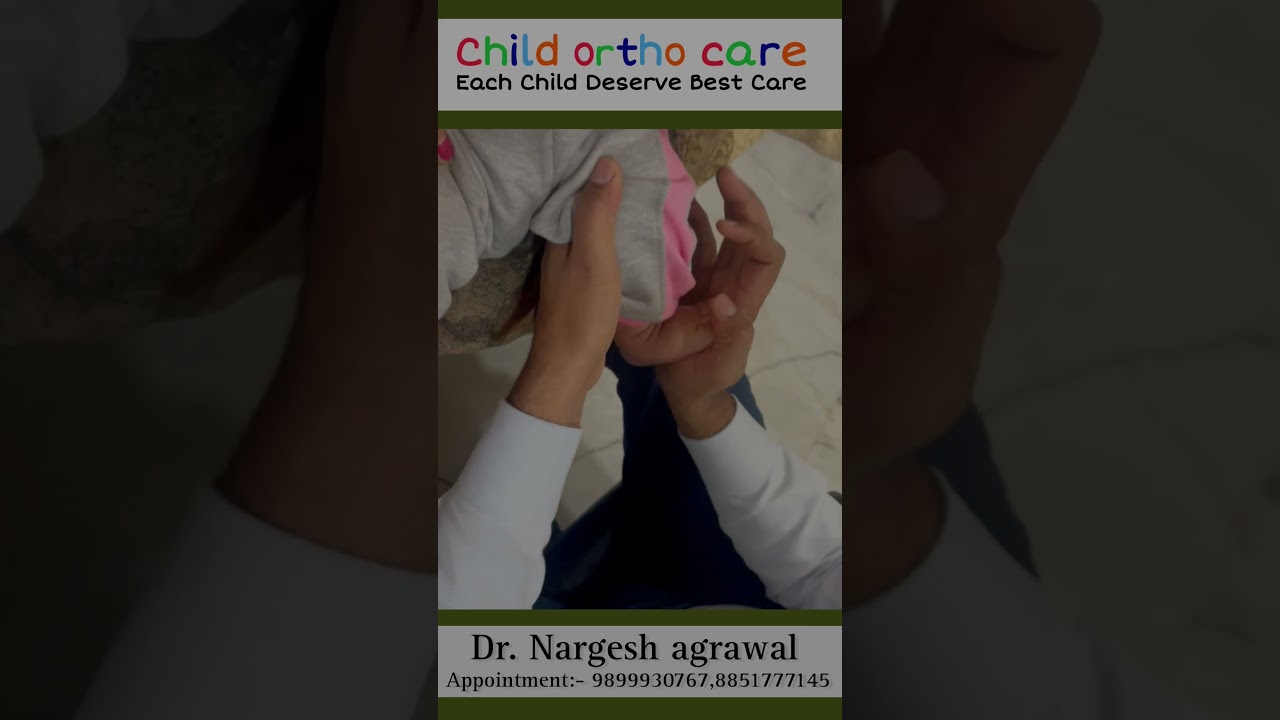 Clubfoot/ Ctev treatment in Delhi #clubfoottreatment #childorthocare #clubfoot #ctev #टेडेमेडेपाँव