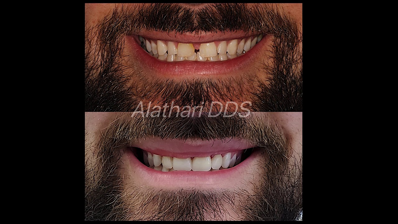 Veneers