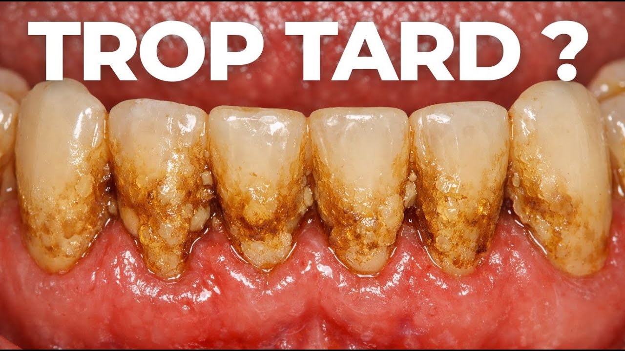 GINGIVITE : Le dernier avertissement avant l'implant