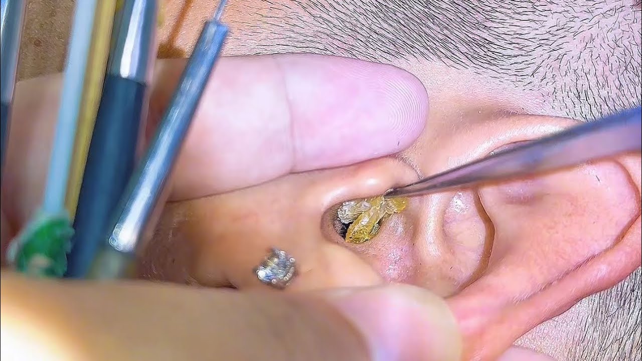 Ultimate Ear Cleaning Compilation! Wait For The End 😱💥