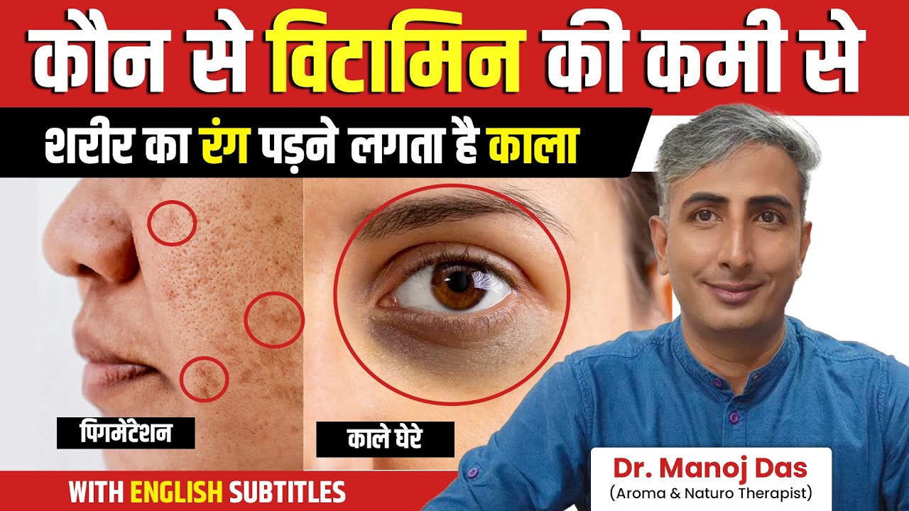 पिगमेंटेशन को जड़ से खत्म करने के उपाए | Get Rid of Hyperpigmentation Naturally | Dr. Manoj Das