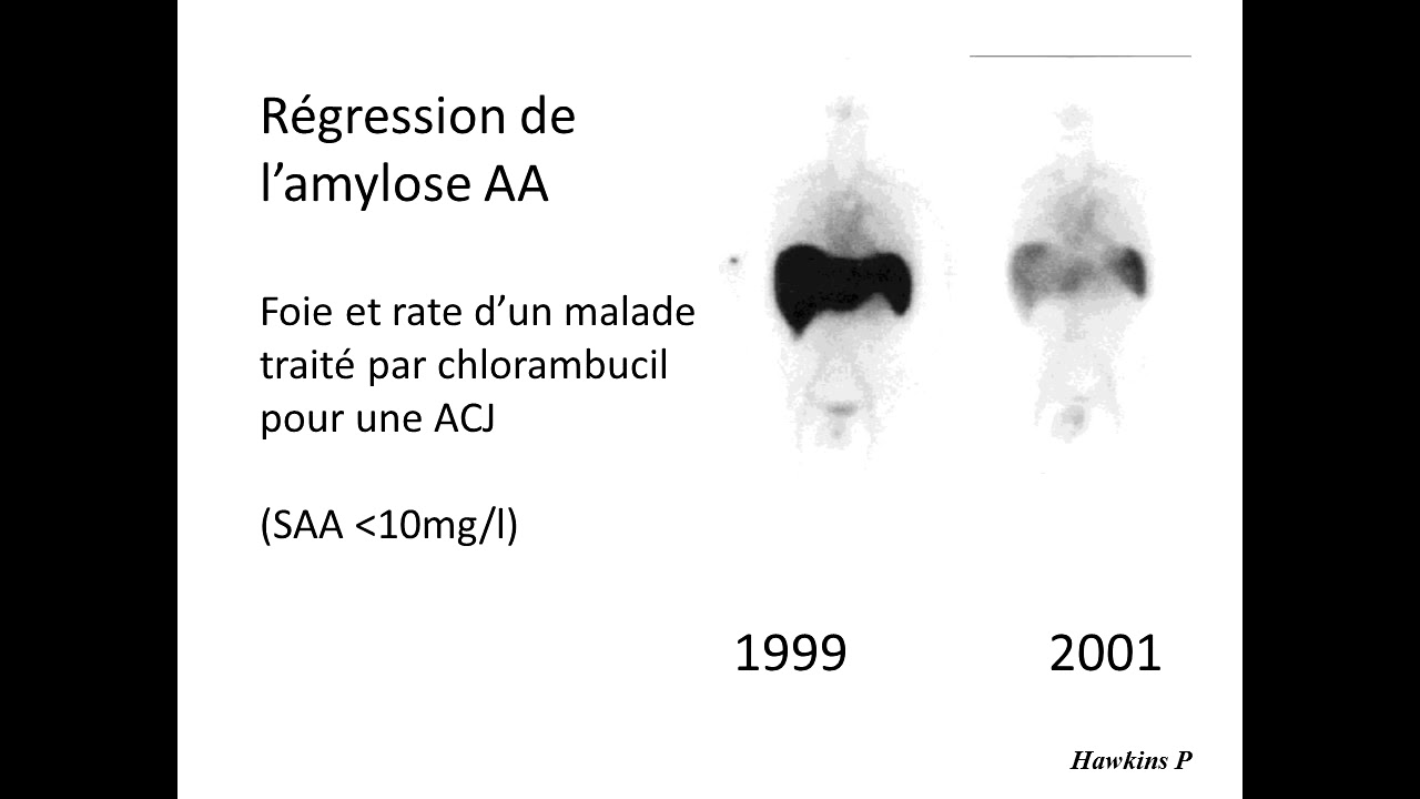 Pourquoi_les_fibrilles_amyloides_d'Amylose AA sont_toxiques?_Gilles GRATEAU