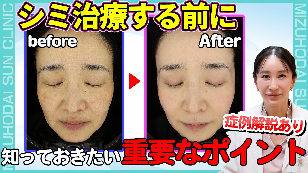 【シミ治療】今が治療に最適！シミ治療に重要なポイントをご紹介！