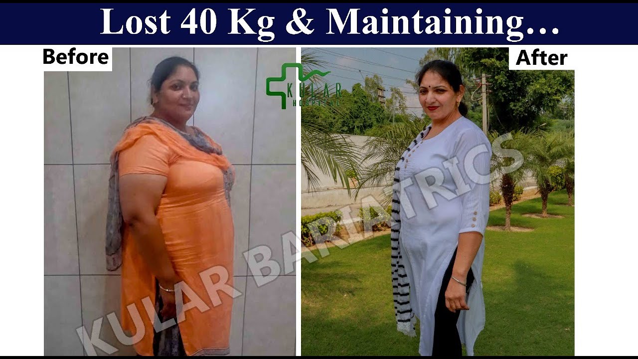 Housewife sharing her experience of Weight Loss Surgery, 3 years after Mini Gastric Bypass Surgery