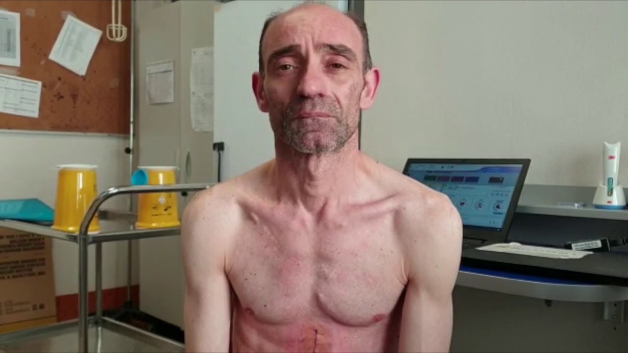 La storia di Saverio, affetto da sindrome di Brugada e portatore di Defibrillatore