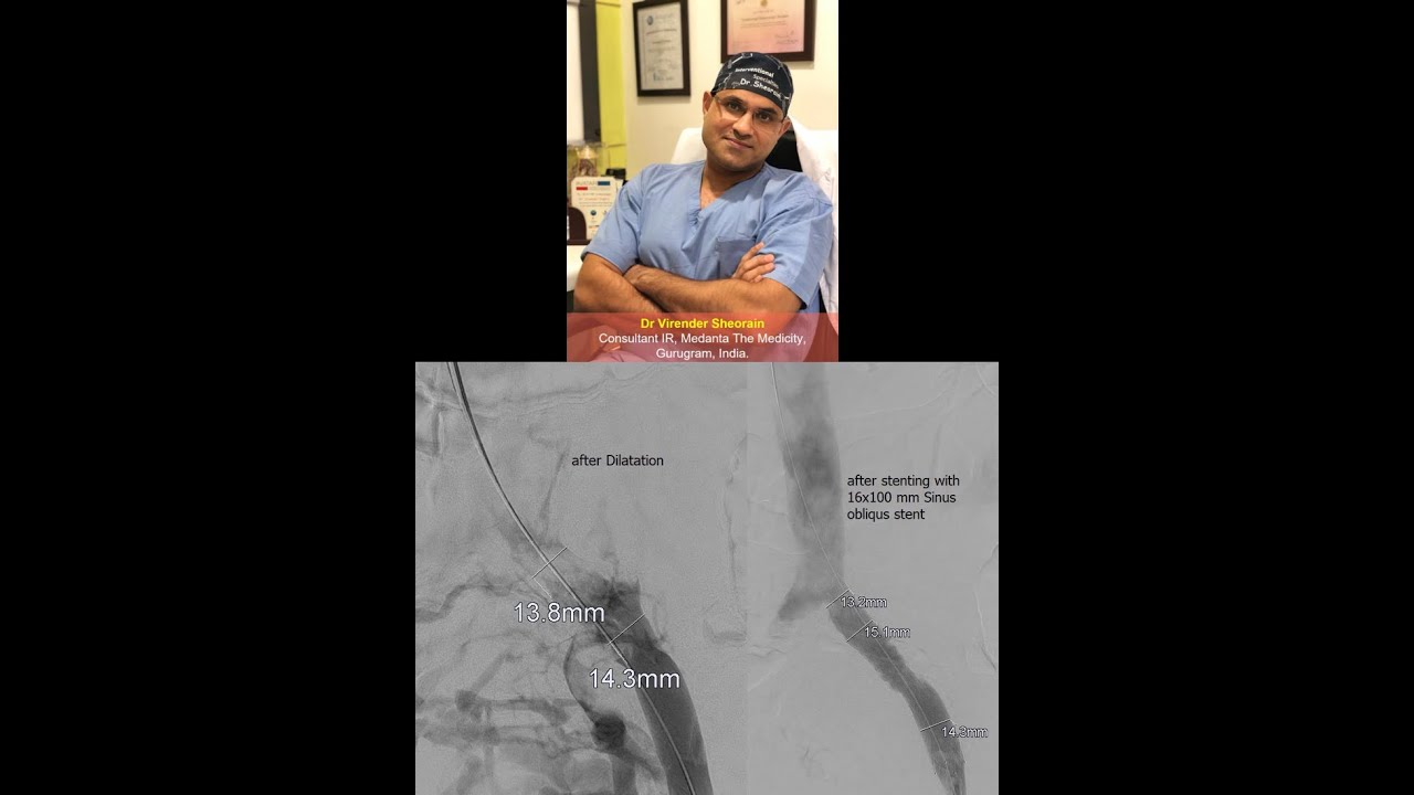ISVIR Webinar # 5 : Endovascular management of acute DVT: Practical approach