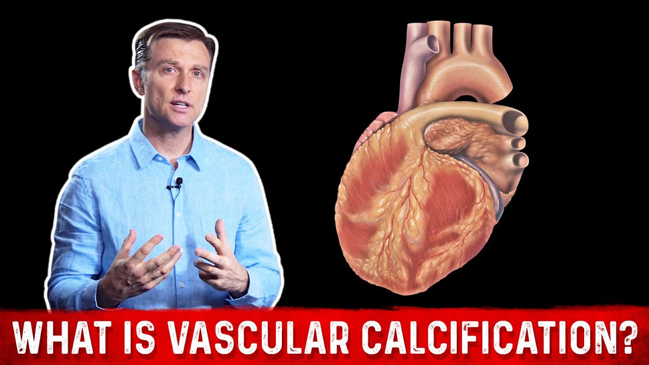 What Is Vascular Calcification? &ndash; Dr.Berg