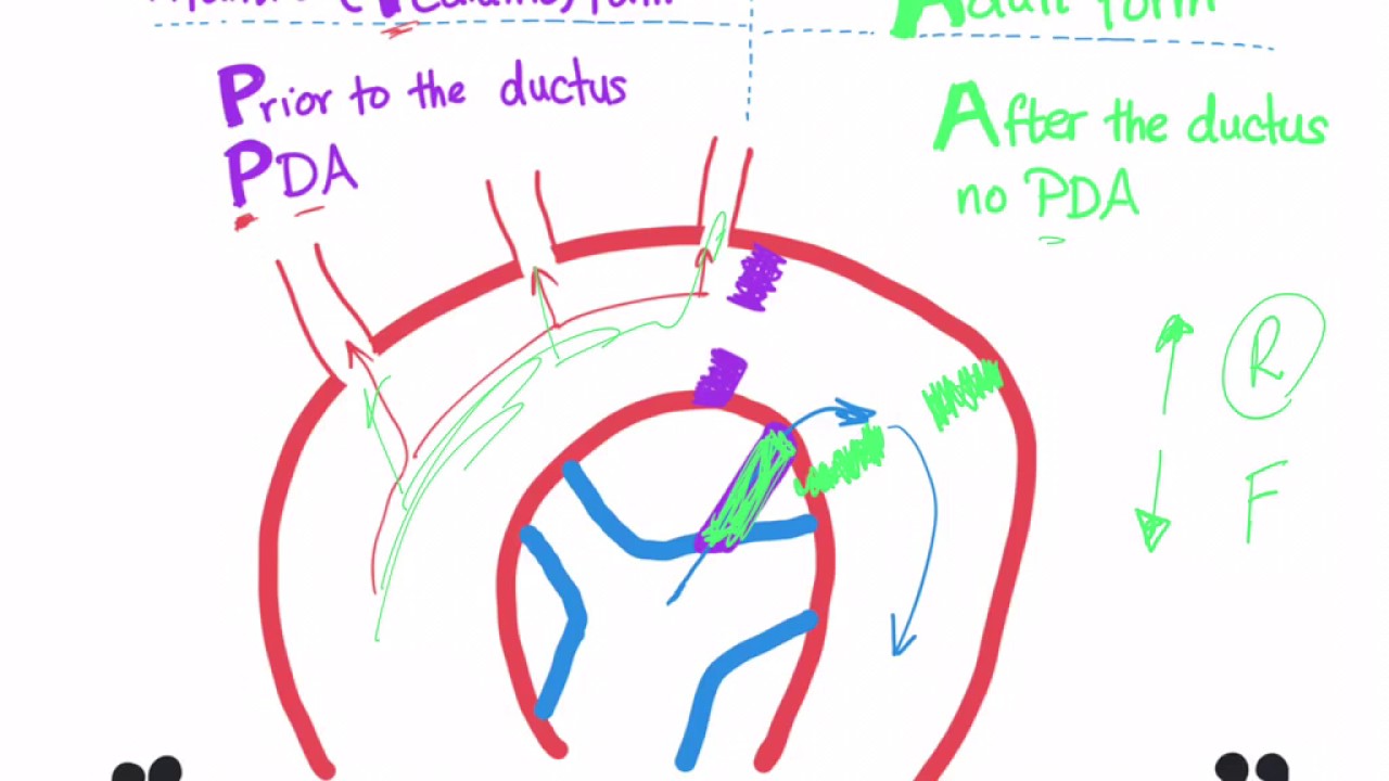 Coarctation of aorta (Infantile type vs adult type) mnemonic