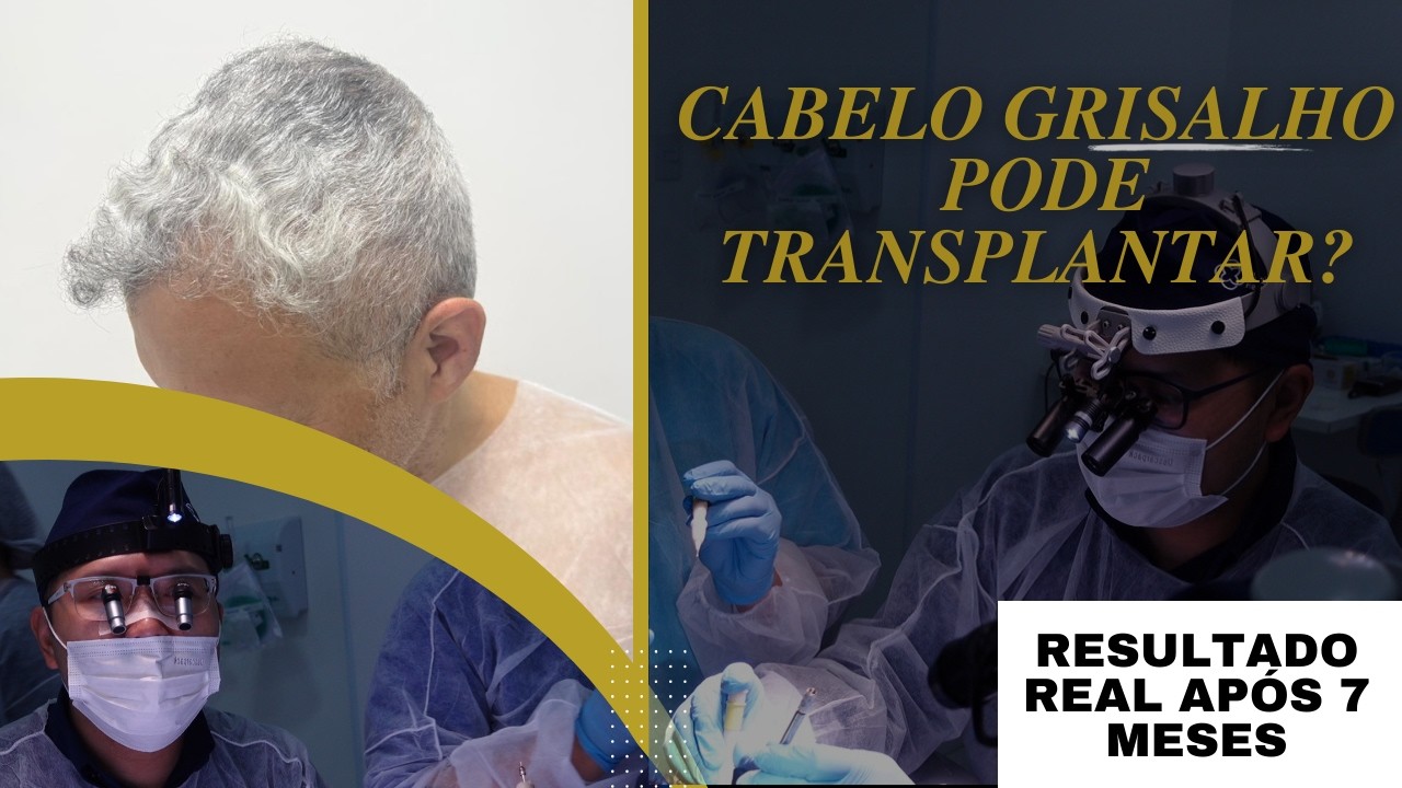 Resultado de transplante capilar em paciente cabelo #grisalho  7 meses de evolução e mesoterapia