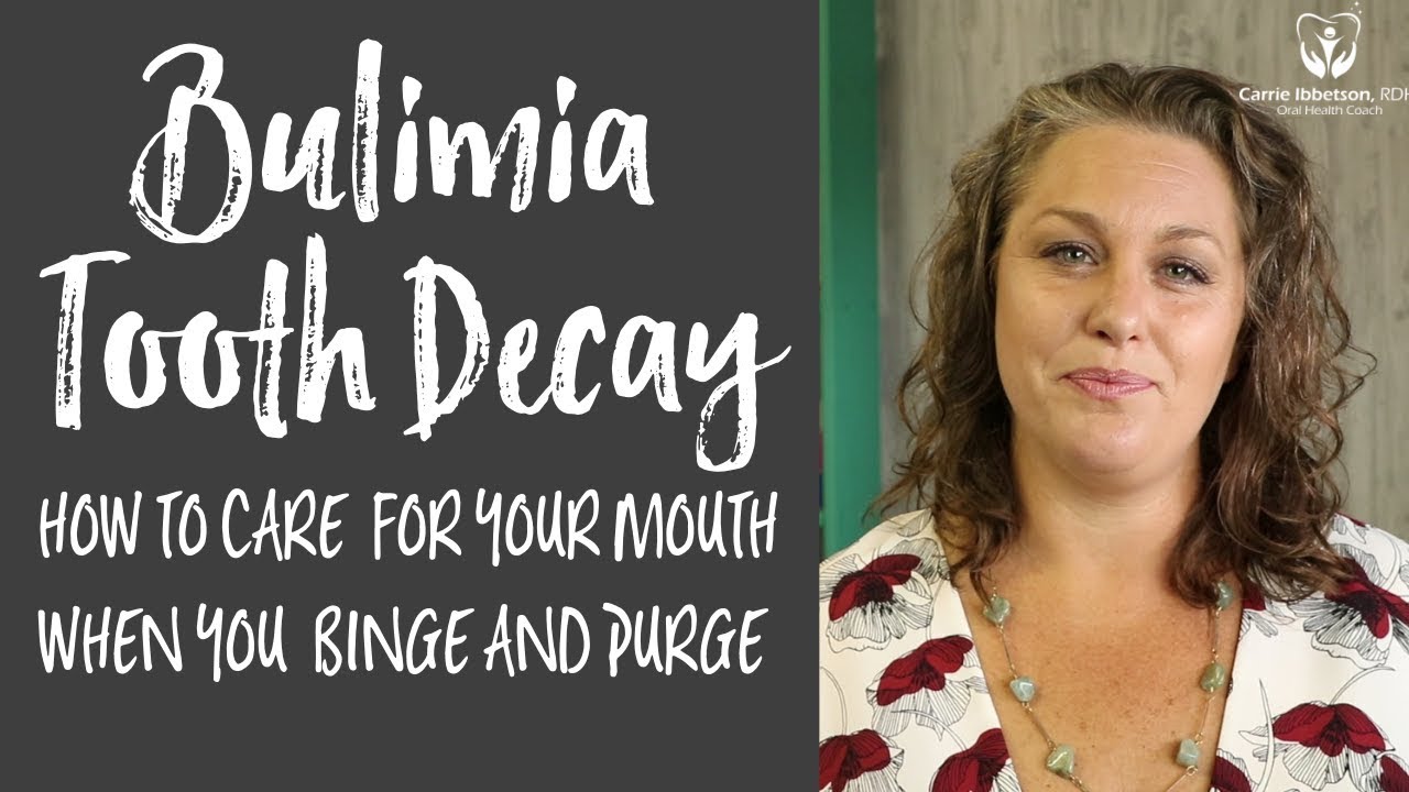 Bulimia Tooth Decay - Take Care of your Mouth when you are Binging and Purging