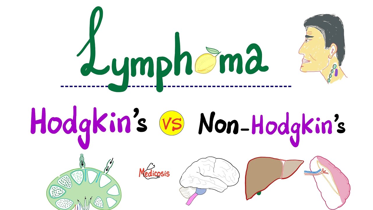 Hodgkin’s Lymphoma vs Non-Hodgkin's Lymphoma - Comparison - Hematology and Oncology
