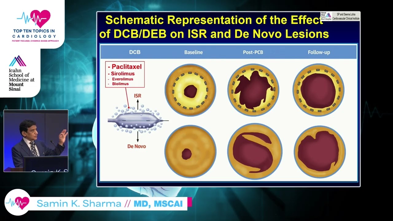 Top 10 Trials of Coronary Interventions in 2025 - Samin Sharma, MD