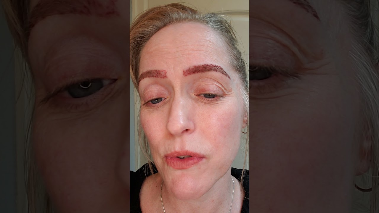 Day 1 : 2nd treatment AFTER:  Saline Tattoo Removal on my eyebrows (microblading EPIC FAIL)