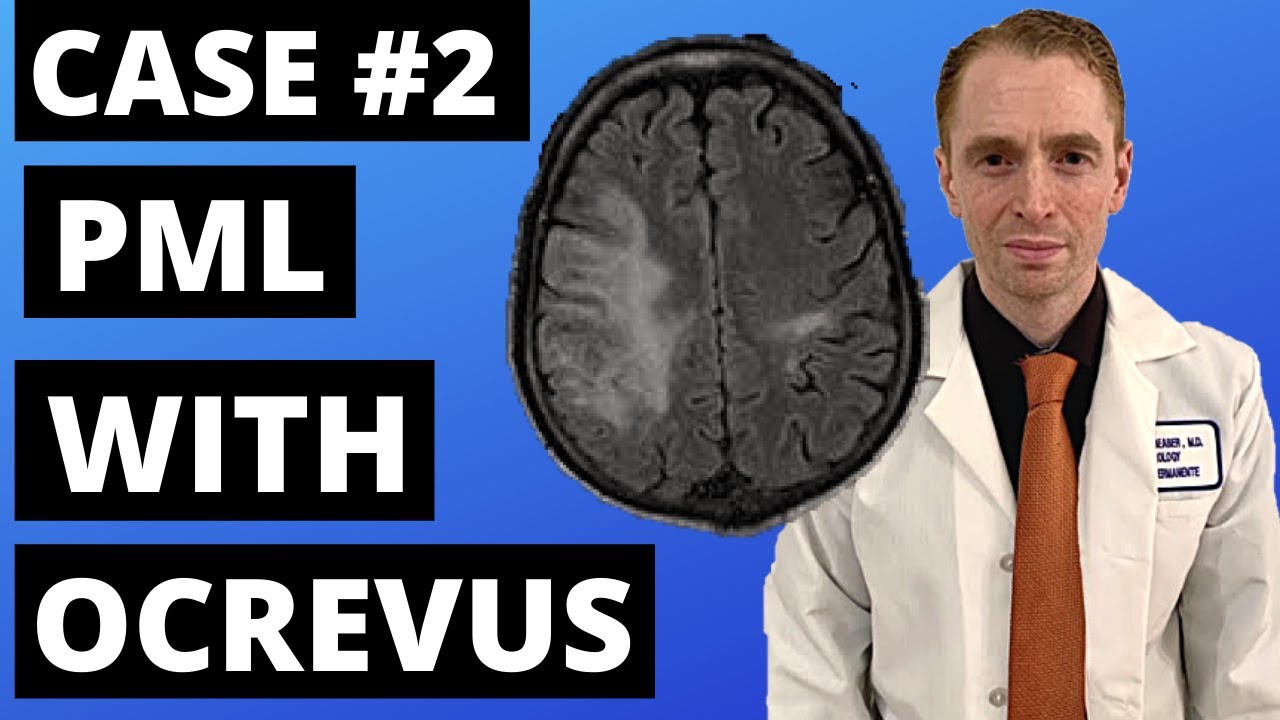 2nd PML Case With Ocrevus Reported by Genentech