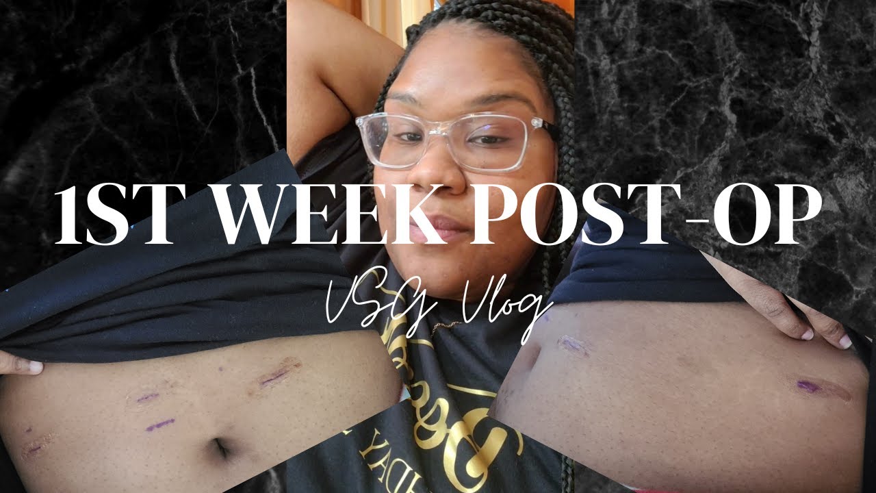 VSG 2 Weeks Post-Op | My VSG Weightloss Journey | Vlog 05