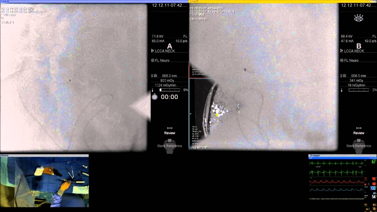 Endovascular transarterial embolization of cerebral AVM with ethylene-vinyl alcohol copolymer