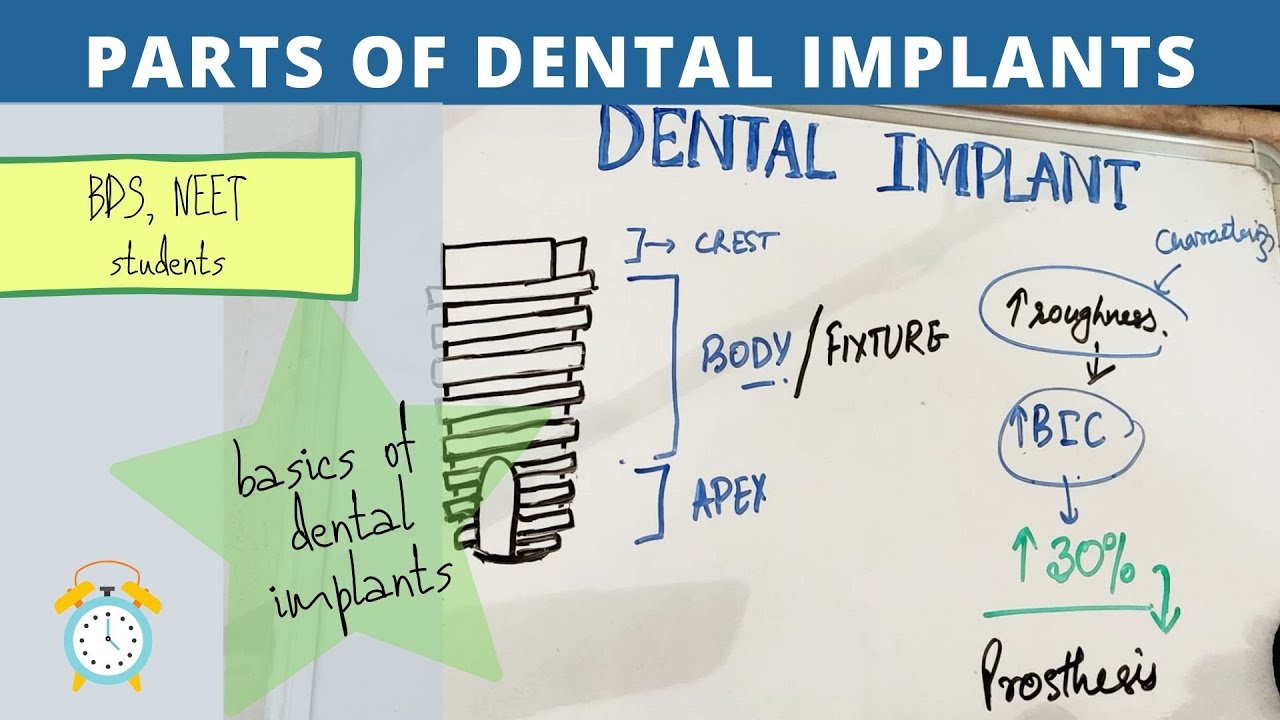 basics of dental implants - parts of implant