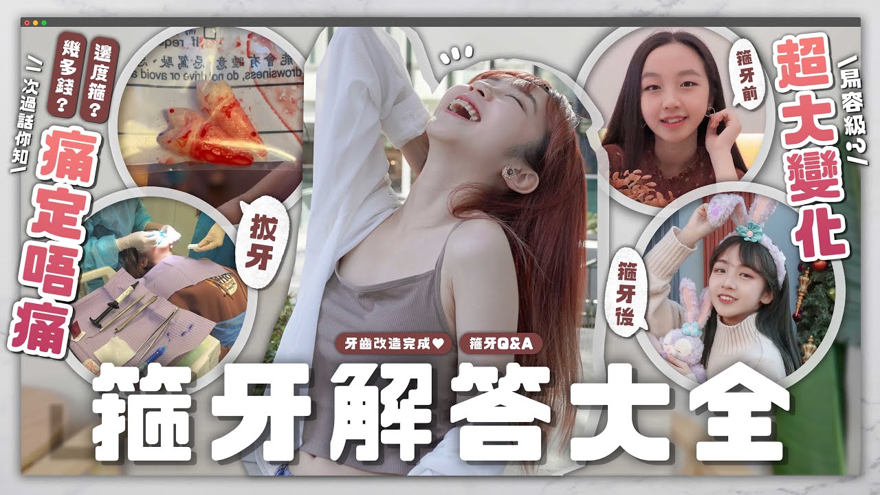 〖箍牙Q&A🦷〗箍完整容級改變 ?!😱箍牙真的可以瘦面？￼剝牙痛爆？幾錢邊度箍一次過答你❤️｜牙齒改造完成🦷