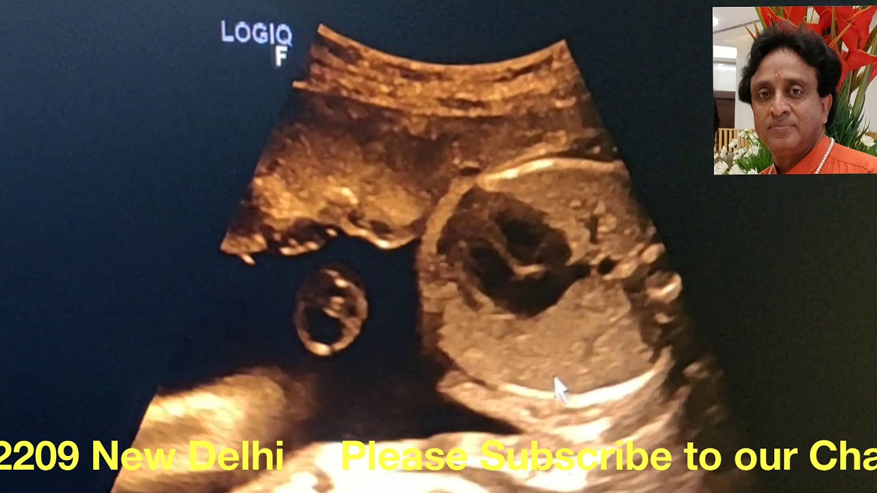 Situs Solitus or Situs Inversus How to Decide on Pregnancy Ultrasound, tricks and tips