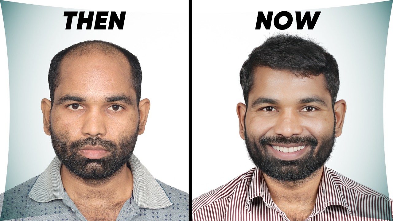 Hair Transplant in Delhi (HX-YTGB) | Best Results & Cost of Hair Transplant in Delhi.