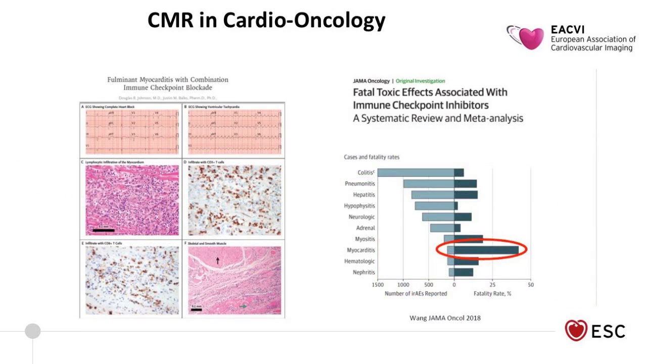EACVI free webinar:  Highlights of EuroCMR 2019