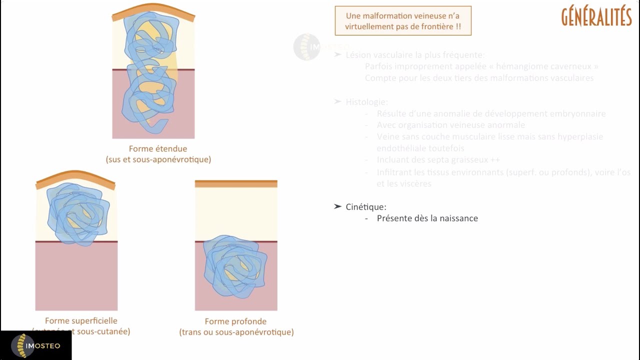 TUTORIEL IMOSTEO #25 : Sémiologie des malformations veineuses en imagerie