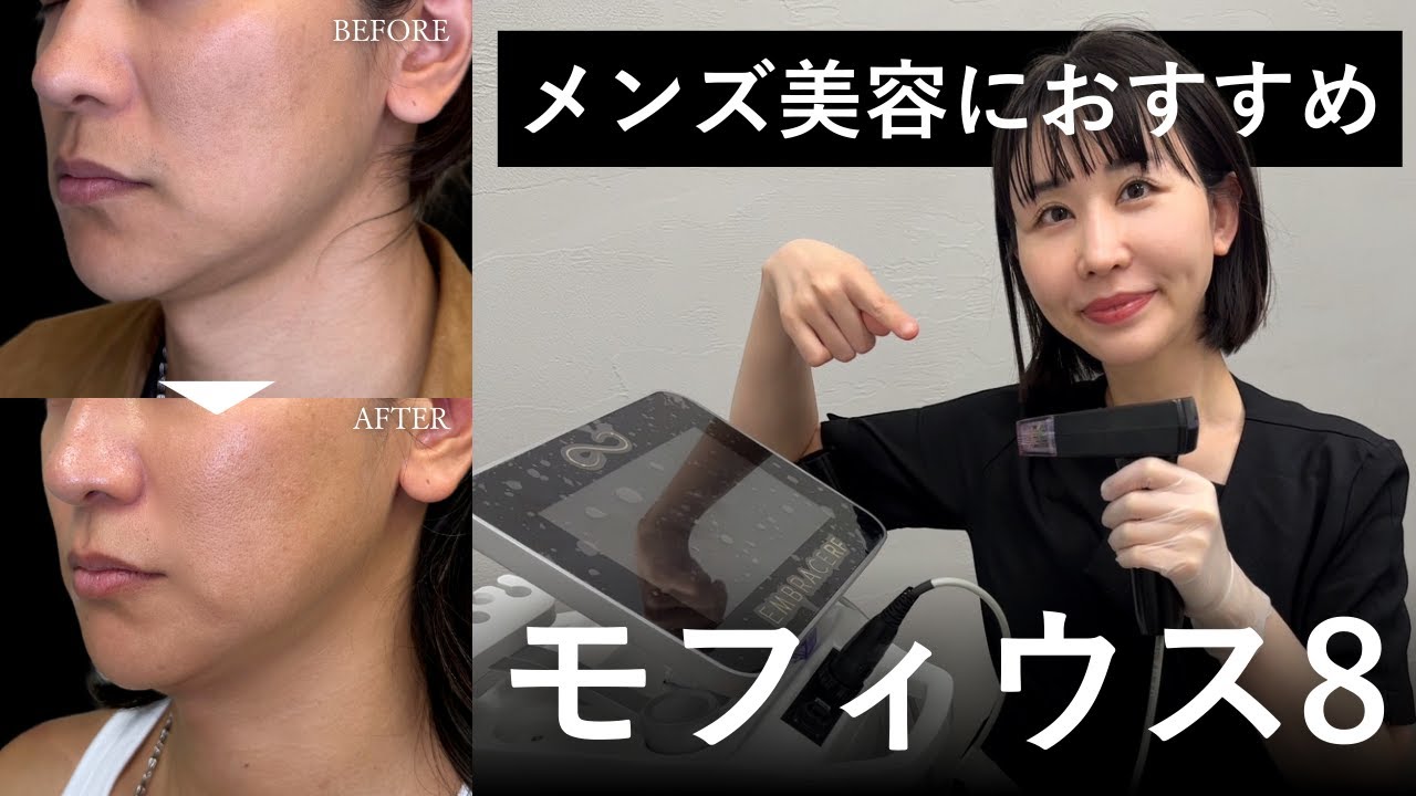 痛みの本音も暴露！モフィウス8で男の若返り｜たるんだフェイスラインに衝撃！