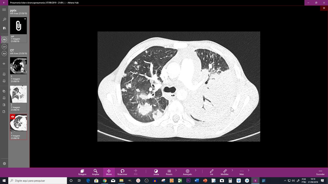 Pneumonia lobar e broncopneumonia