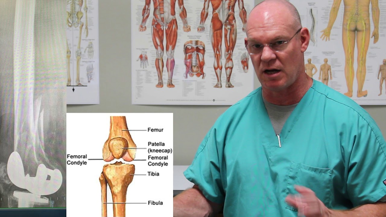 Distal Femur Fracture | Fracture Friday Episode 15