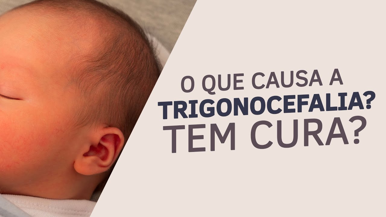 Trigonocefalia em Bebê TEM CIRURGIA? O que é, Quais são as causas, Sequelas e Tratamentos?