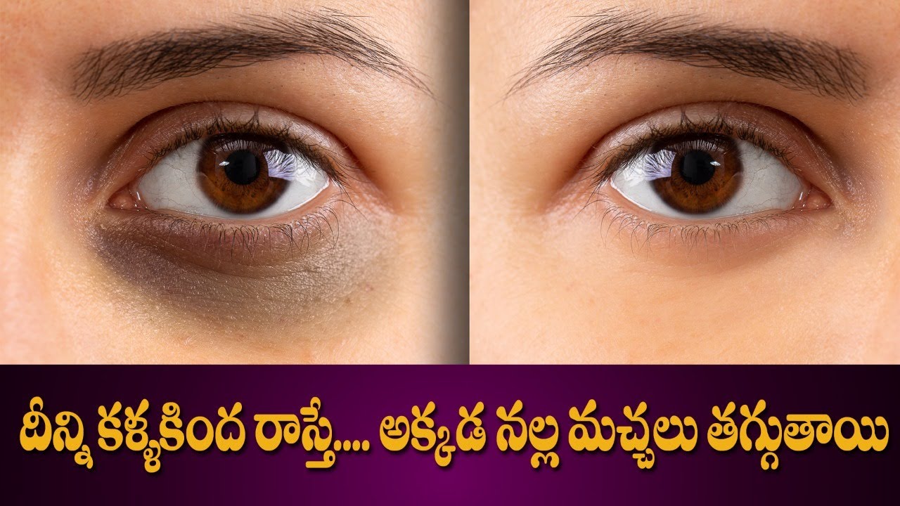 Home Remedy to Remove Dark Circles | Tightens Loose Skin | Glowing Skin | Dr. Manthena's Health Tips